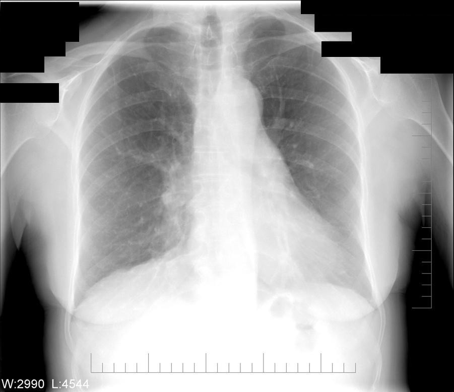 American Thoracic Society Airflow Obstruction and Dysphonia in a