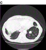 Lung Cancer Screening Figure