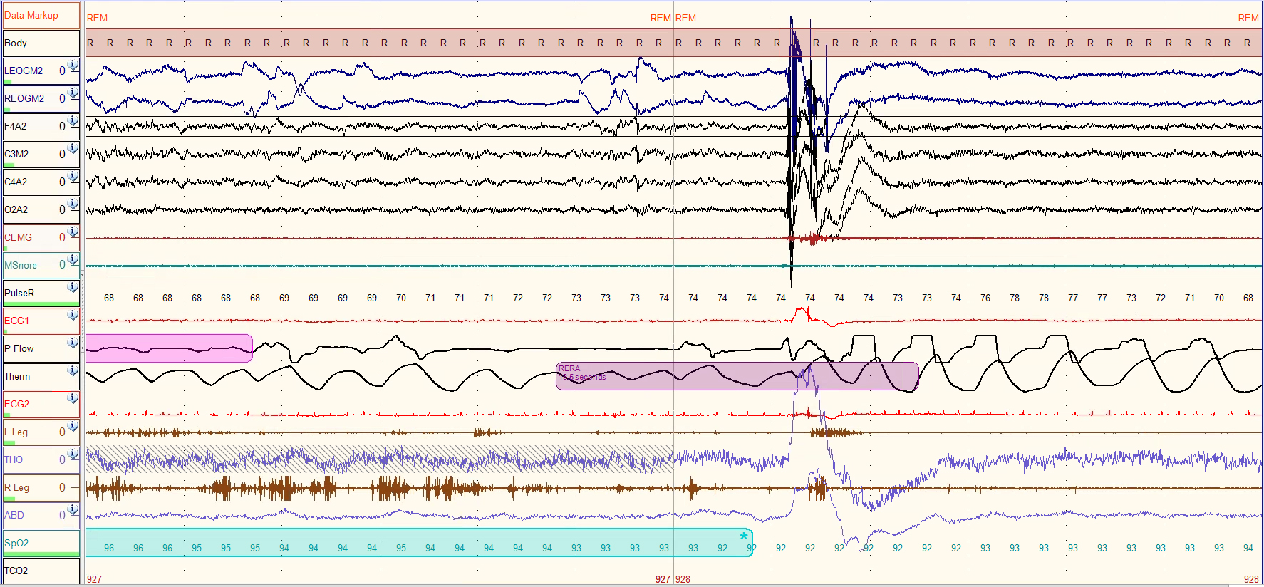Image of the day - RBD vs pseudo-RBD