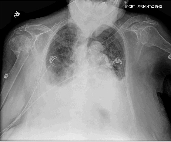 Egg Shell Calcifications In A 69 Year Old Woman