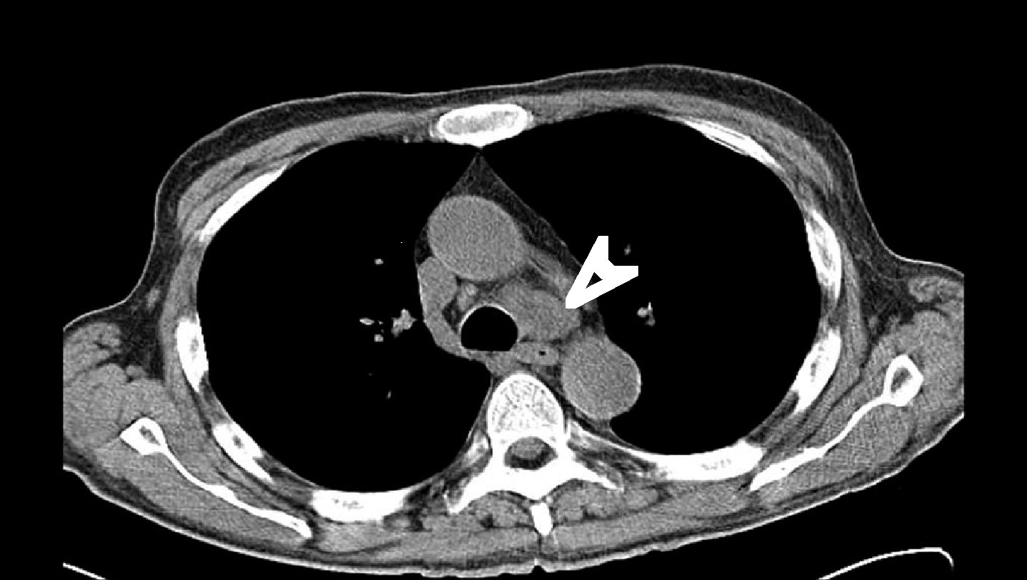 Suspicion of Lung Cancer with Nodal Metastases in an Immunocompromised