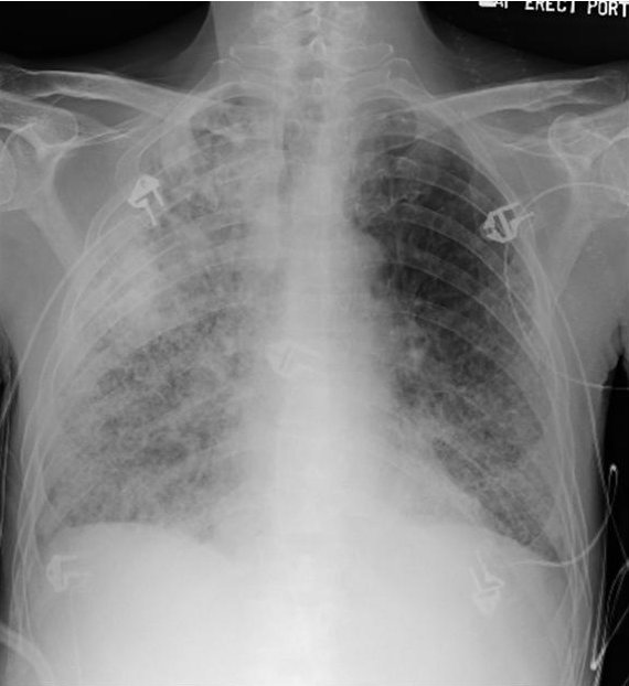 A 60-Year-Old Man with Acute Respiratory Failure and Mental Status Changes