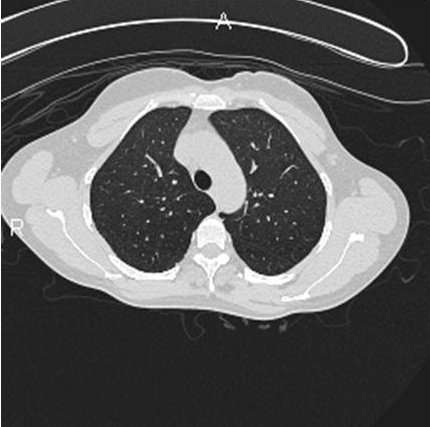 Interstitial Lung Disease In A Hot Tub User