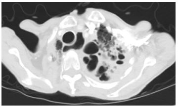 an-unexpected-etiology-of-ventricular-dysrhythmia