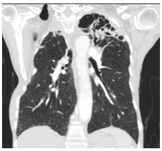 an-unexpected-etiology-of-ventricular-dysrhythmia