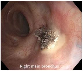 an-unexpected-etiology-of-ventricular-dysrhythmia