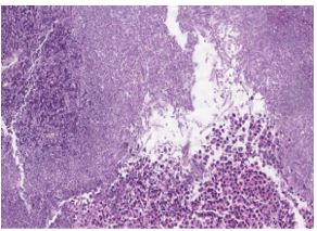 an-unexpected-etiology-of-ventricular-dysrhythmia