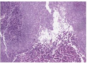 an-unexpected-etiology-of-ventricular-dysrhythmia