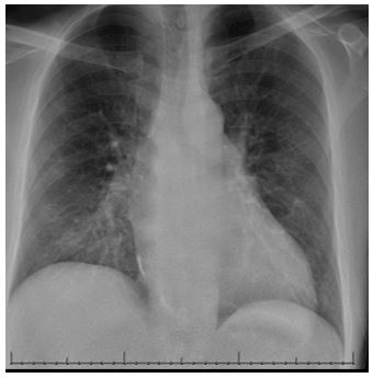 an-unexpected-etiology-of-ventricular-dysrhythmia