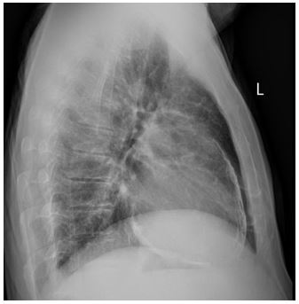 an-unexpected-etiology-of-ventricular-dysrhythmia