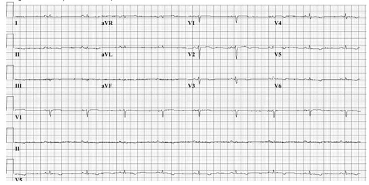 an-unexpected-etiology-of-ventricular-dysrhythmia