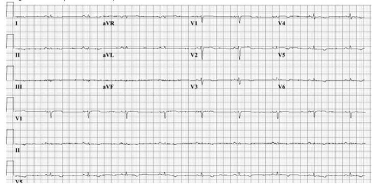 an-unexpected-etiology-of-ventricular-dysrhythmia