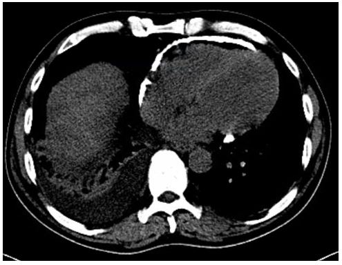 an-unexpected-etiology-of-ventricular-dysrhythmia