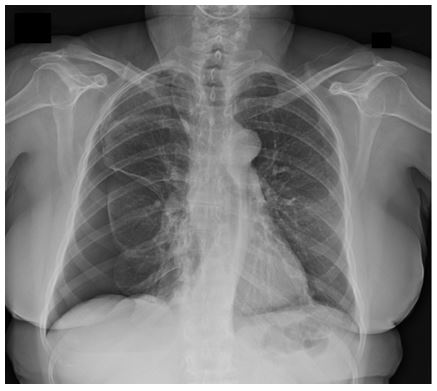 an-unexpected-etiology-of-ventricular-dysrhythmia