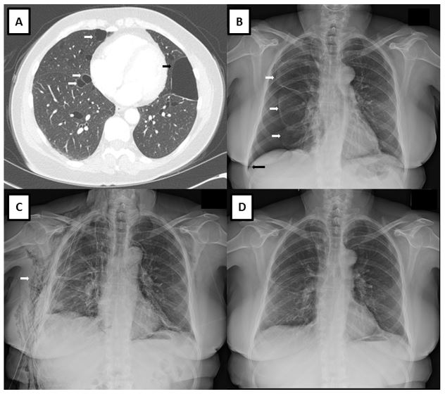 acute-onset-shortness-of-breath-pleuritic-chest-pain-and-cough-2