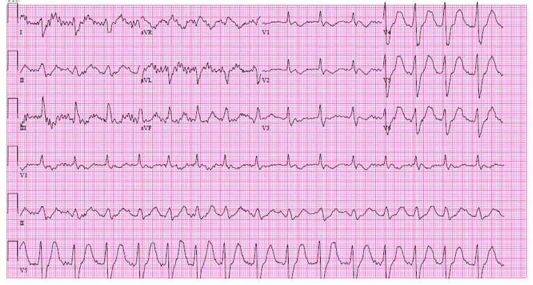 an-unexpected-etiology-of-ventricular-dysrhythmia