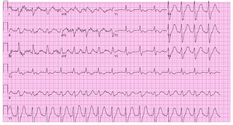 an-unexpected-etiology-of-ventricular-dysrhythmia