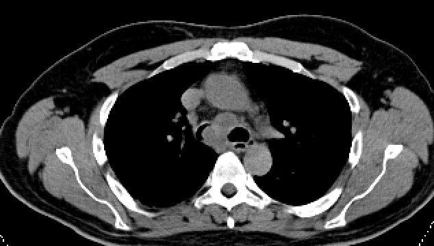 bronchoscopy