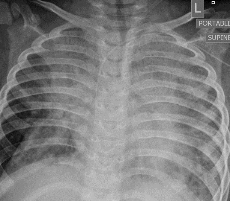 Chest radiograph