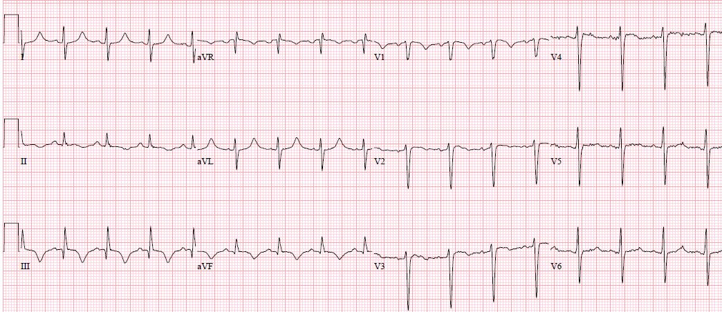 Common Strain of Dyspnea