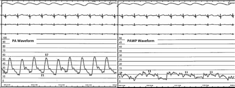 distressing-dyspnea-in-a-patient-with-lupus-and-diagnosis-of-pulmonary-arterial-hypertension-by-right-heart-catheterization