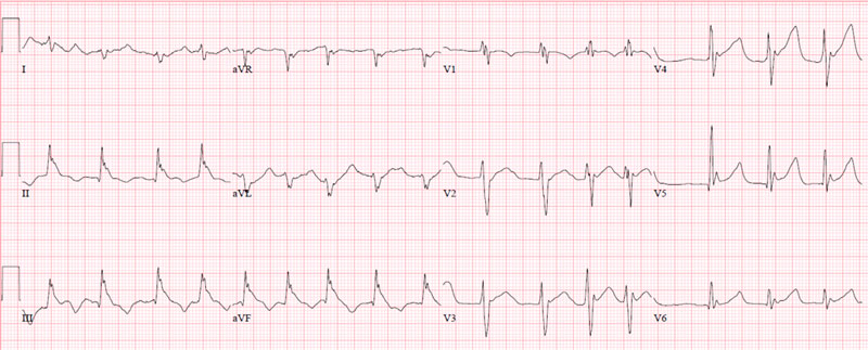 EKG