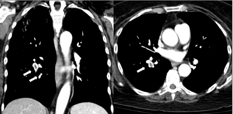 endobronchial 2