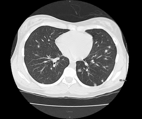 fever chest pain and pulmonary nodules 1