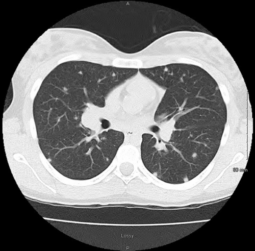 fever chest pain and pulmonary nodules 2