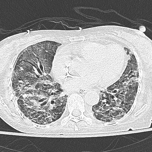 gripping case of myositis