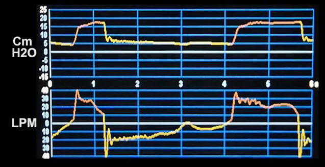 Riding the Waves: Ventilator Waveform Interpretation – CriticalCareNow