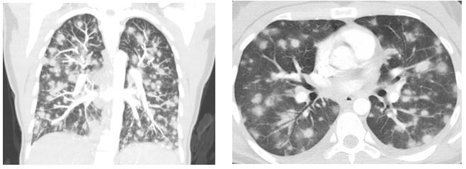 Lots of Lung Nodules 1