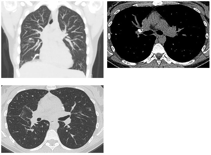 Lots of Lung Nodules 2