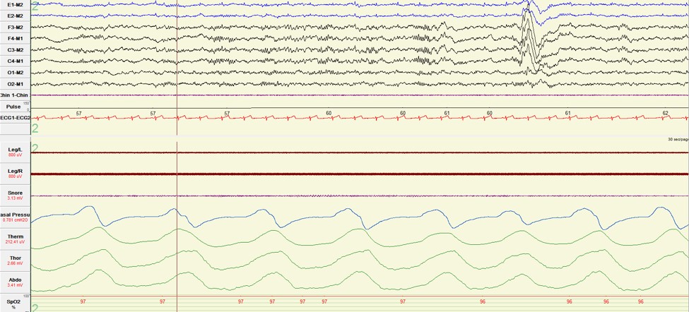 Catathrenia (Sleep Groaning): Causes and Treatment