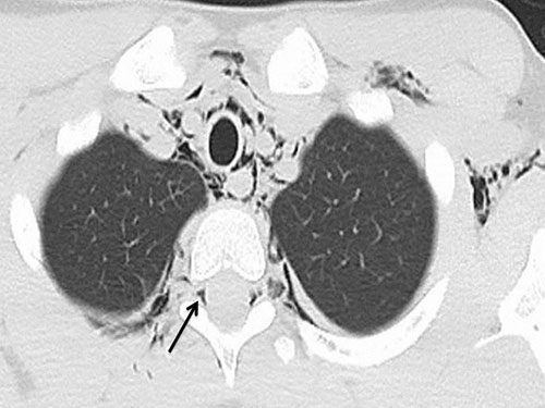 Pneumomediastinum with Pneumorrhachis