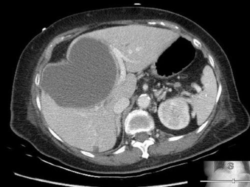 sweeney polycystic liver