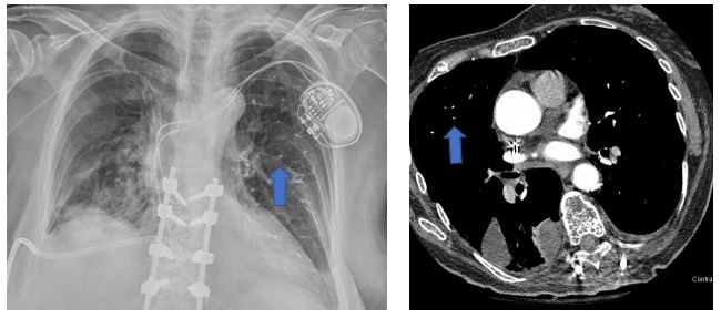 an-unexpected-etiology-of-ventricular-dysrhythmia