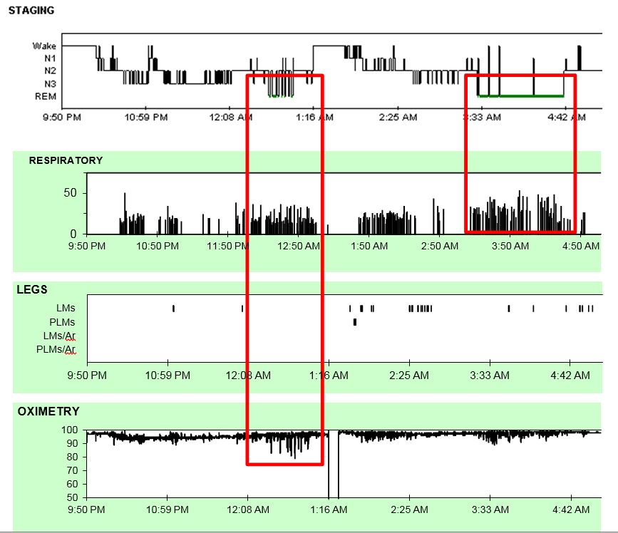 sample hypnogram