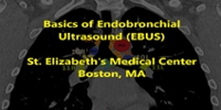 EBUS Basics and Mediastinal Staging