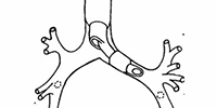 Endobronchial Blocker Placement