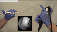 Transbronchial Biopsies