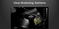 Ultrasound Artifacts